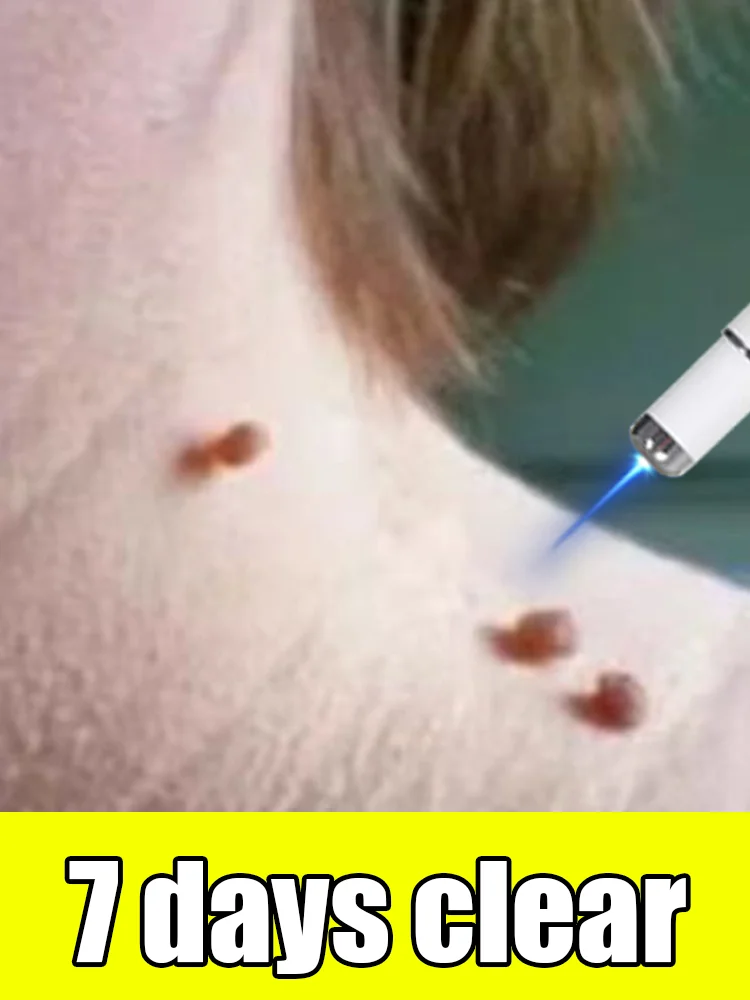 

Second Generation Wart Tool Beauty Pen