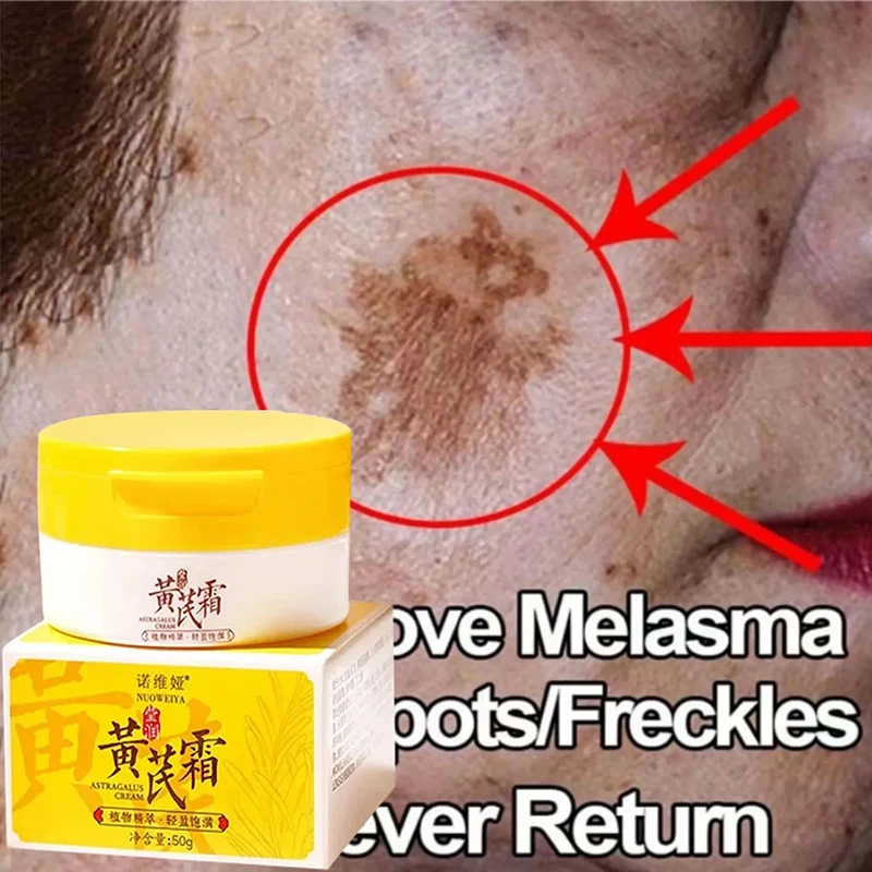 50g Astragalus Blemish Cream Removal Melasma Melanin Whitening Brighten Moisturing Face Care Botanical Extract Mild Glow Recipe