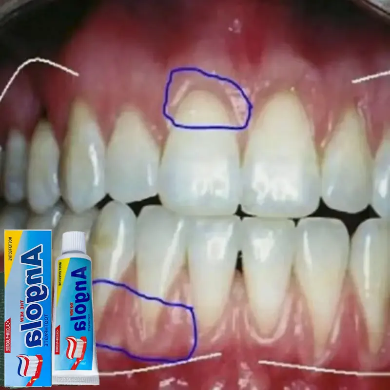 Remove Tartar Remove Oral oOdor Effective Products For Prevention Of Periodontitis