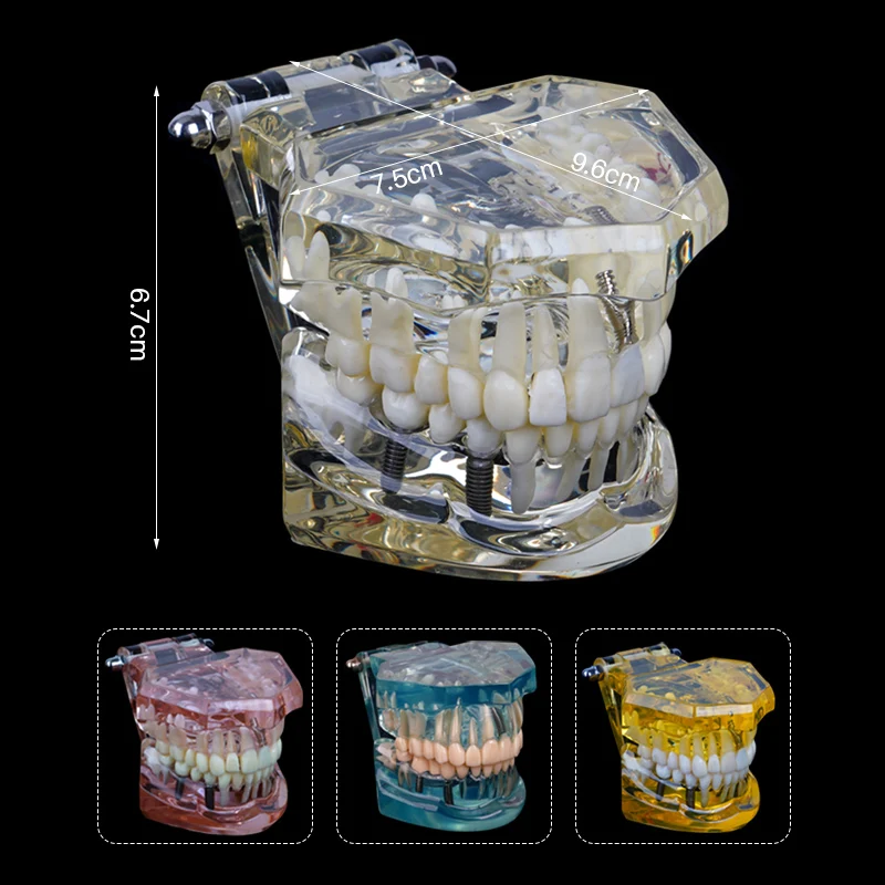 Dental Models Removable Implant Diseased Teeth Models For Teaching Researching Medical And Dental Diseases