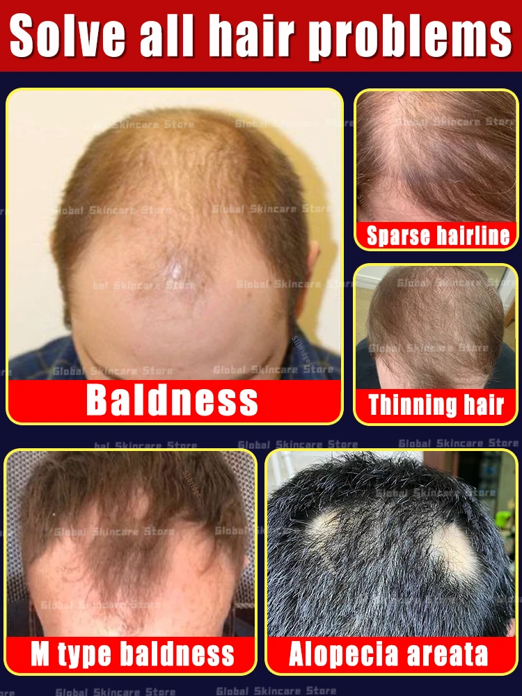 98% of buyers buy again, have more and more hair, say goodbye to baldness, thick hair,Hot selling product