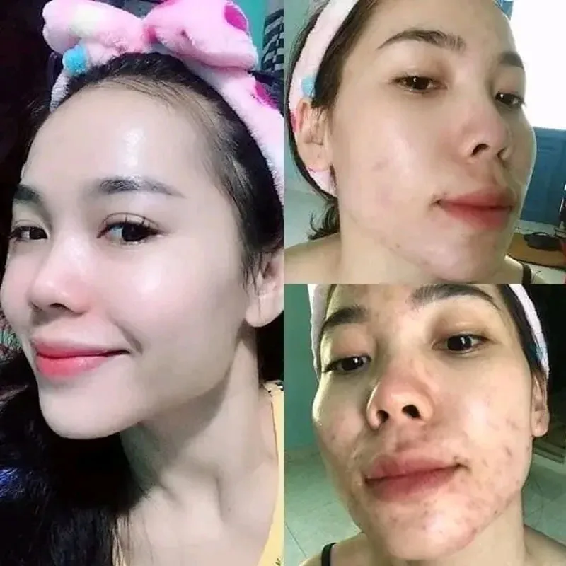 BOT UONG Collagenl-Jeune miles, Élimine les Imperfections Dhydr-Skin, les Taches d'Acné, Peau Blanche Douce, artificiel astique Lisse et Jeune, 1 Hop, 15 Goi