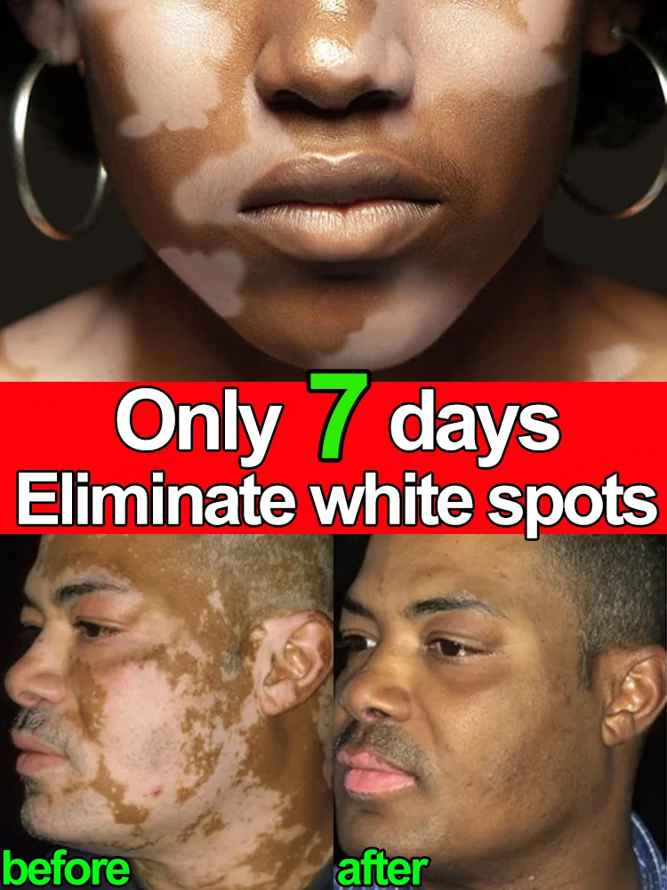 creme de tratamento de vitiligo para aliviar a remoção de manchas brancas na pele