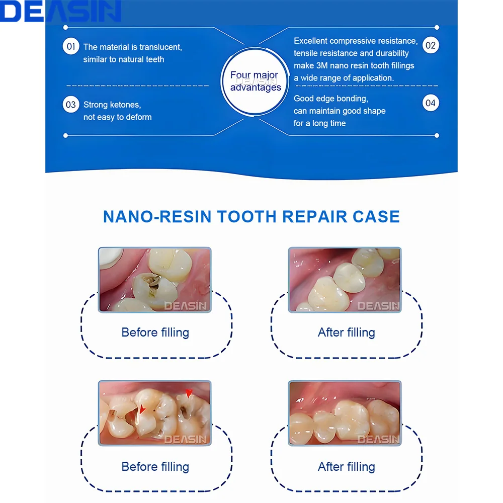 DEASIN 범용 치과 수복 주사기 치아 수복 치과 재료용 광중합 유동성 복합 수지