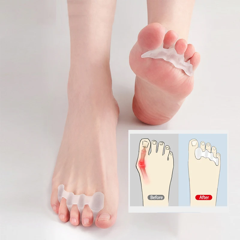 1 Pair Toe Separator Bunion Hallux Valgus Orthosis Overlapping Correctors