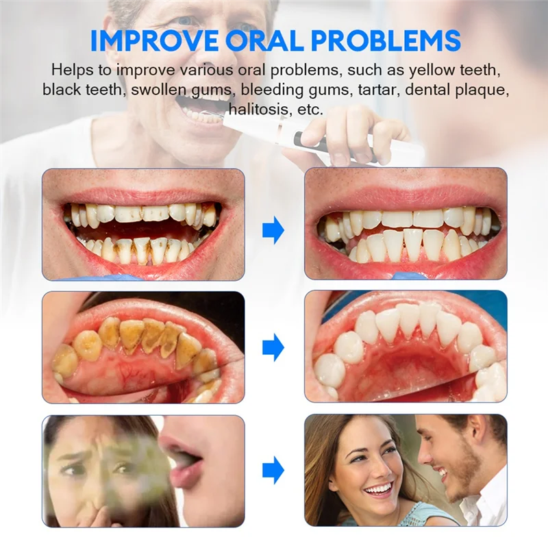 Escalador Dental ultrasónico para dientes, eliminador de cálculo Dental, sarro, placa Dental sónica eléctrica, eliminación de piedra Dental