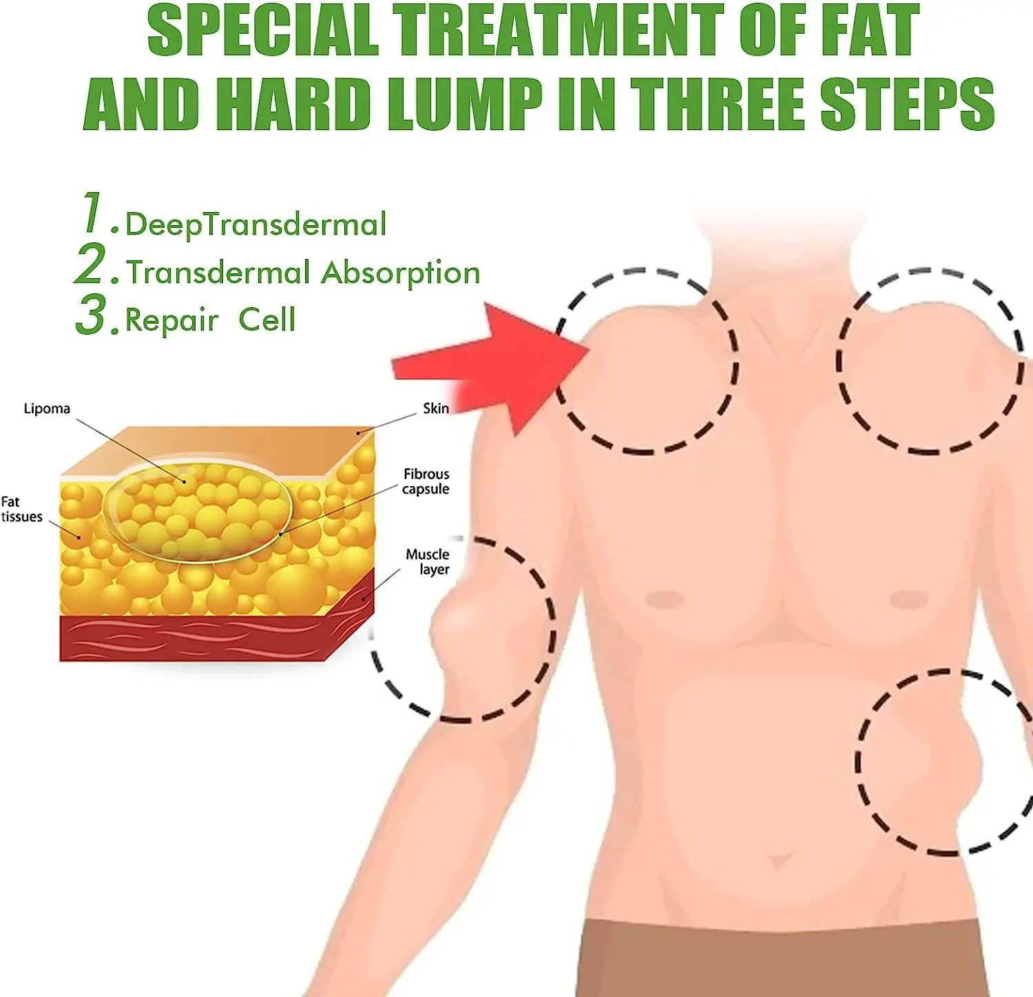 Lipoma salep menenangkan, Lumpfree, krim Anti bengkak kulit