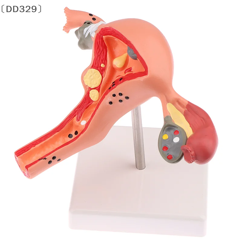 〔DD329〕1Pcs Medical Props Model Pathological Uterus Ovary Anatomical Model Anatomy Cross Section Study Tool