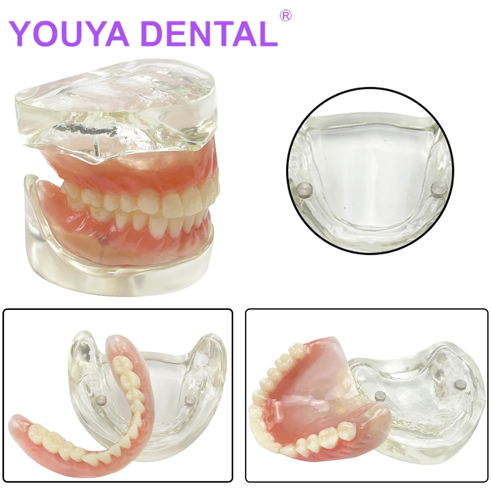 Clear Dental Upper/Lower Teeth Model With Implant Restoration Tooth Model Dentist Teaching Study Removable Bridge Denture Demo