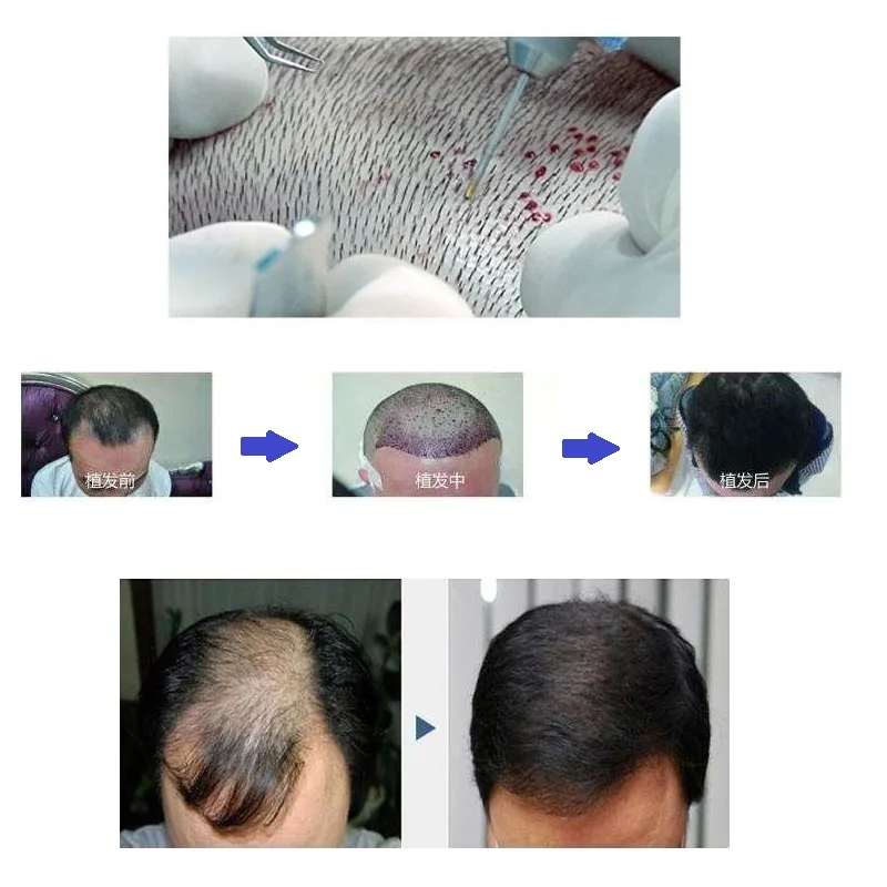 Fue Hair Transplant Hair Follicle Extractor Scarless For Hair Thinning and Balding Treatment Implanted Hair Eyebrow Makeup Tools