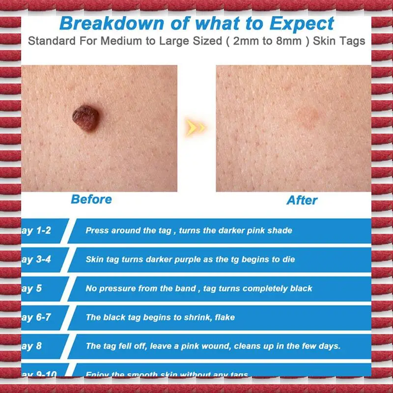 A97G 2X Kit de dissolvant de verrues de taupe d'étiquette de peau dispositif d'élimination d'étiquette de peau avec anneaux en caoutchouc pour outil de soins du visage de verrues de taupe adulte