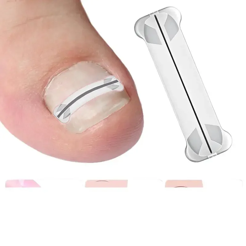 1Pcs 13-20mm Nagel Korrektur Aufkleber Eingewachsene Zehennagel Corrector Patches Paronychie Behandlung Erholen Corrector Pediküre Werkzeuge