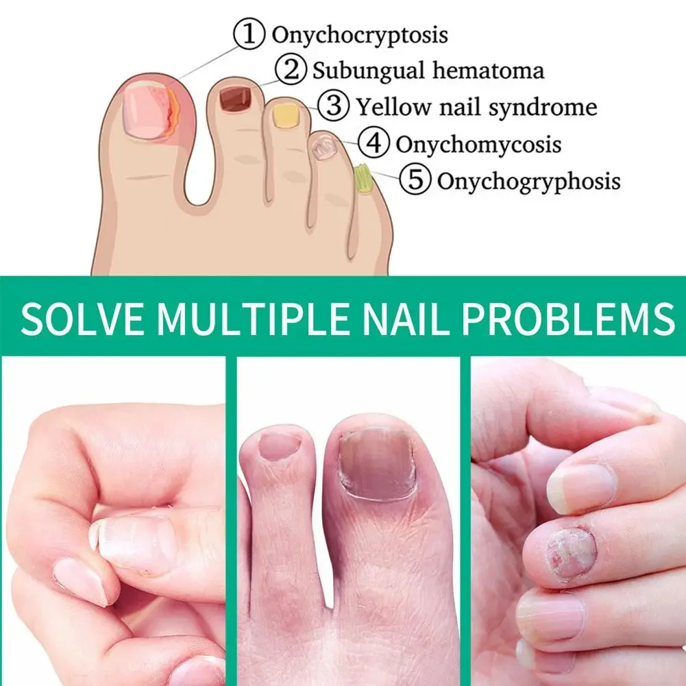 10pcs Extra Strong Nail Fungus Treatment Serum Essence Oil Feet Repair Essence Anti Toe Infection Gel Cream Removal Nails Fungal