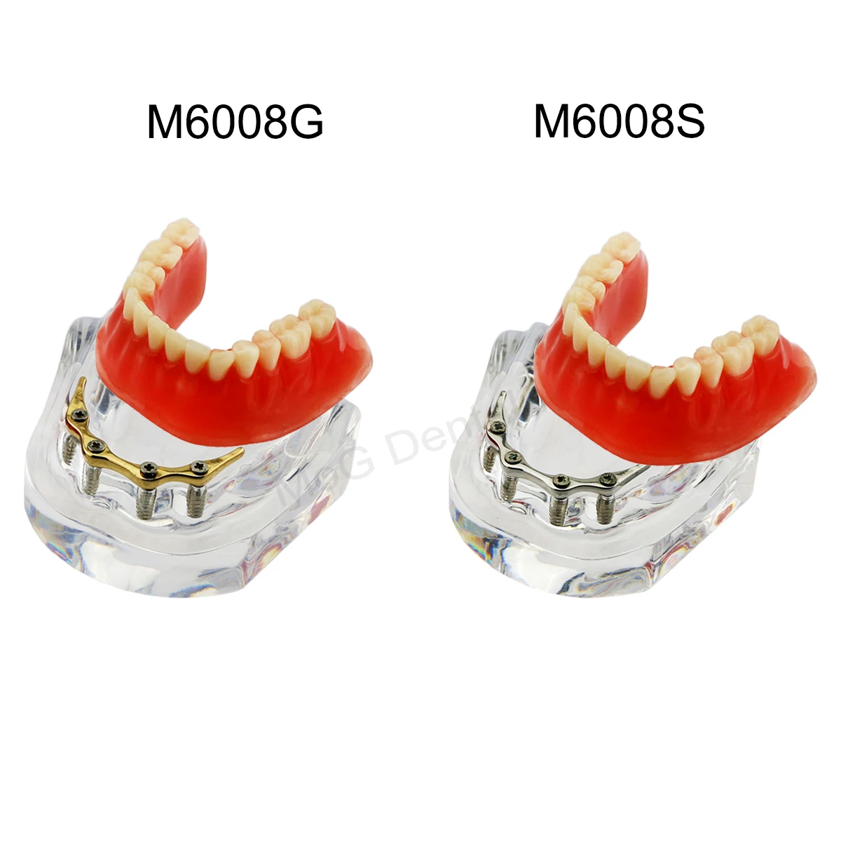 Dental Implant Models with Golden Bar/Silver Bar Overdenture Mandibular Dental Education Model for Dentistry Restoration Demo