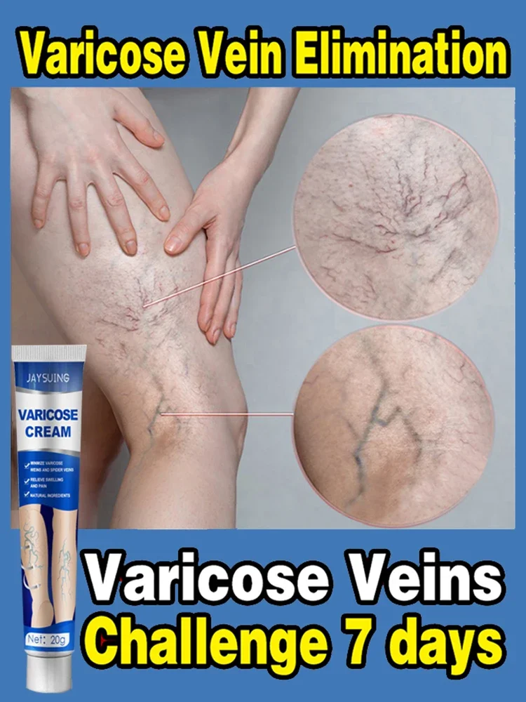 Varicose Vein Treatments Cream Effective Relieve Spider Legs Dilated Vasculitis Phlebitis Natural Formula Ointment