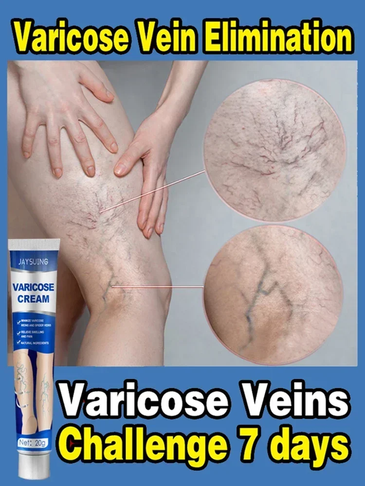 Effective Relief Varicose Vein Ointment Relieve Varicose Vein Vasculitis Spider Legs Pain Treatment Care Essential Cream