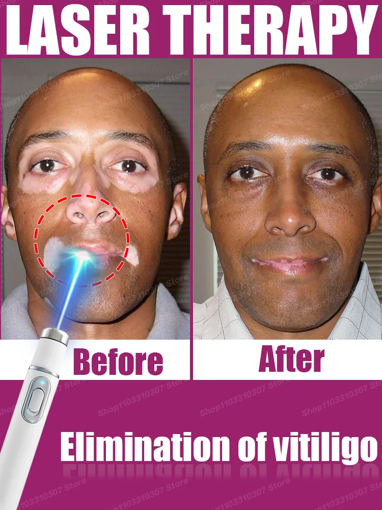 

Vitiligo Quickly White Improves Spots