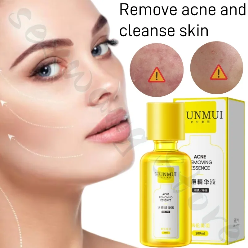 200ml Han Lun Meiyu Essence fades acne marks, closes acne, soothes and tightens skin, nourishes, hydrates and moisturizes face