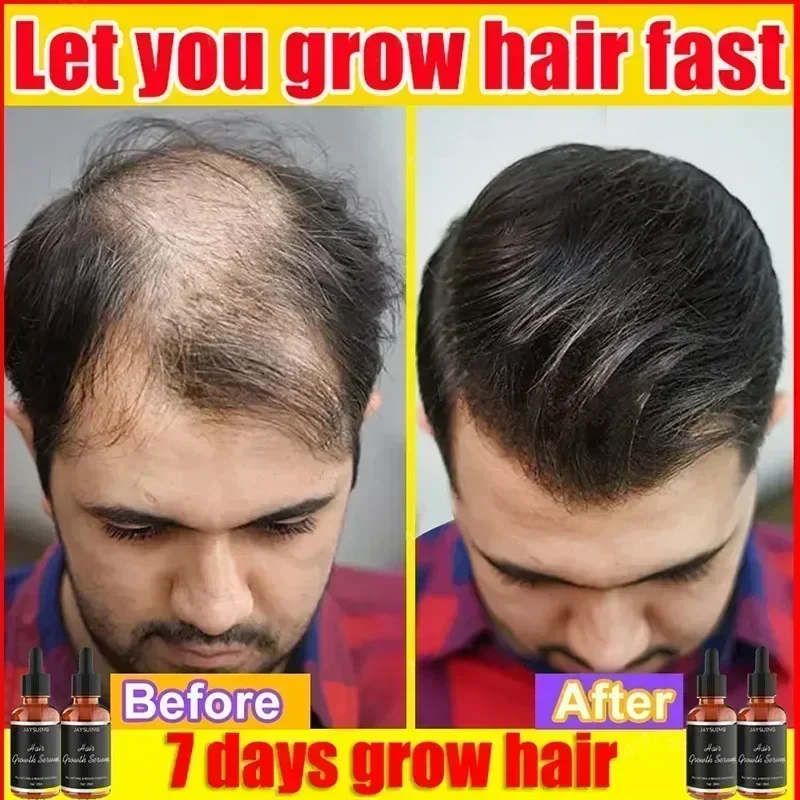 

Hair Growth Products Biotin Anti Hairs Loss Oil Scalp Treatment Fast Growing Hair Care Essential Oils for Men Women Hair Care