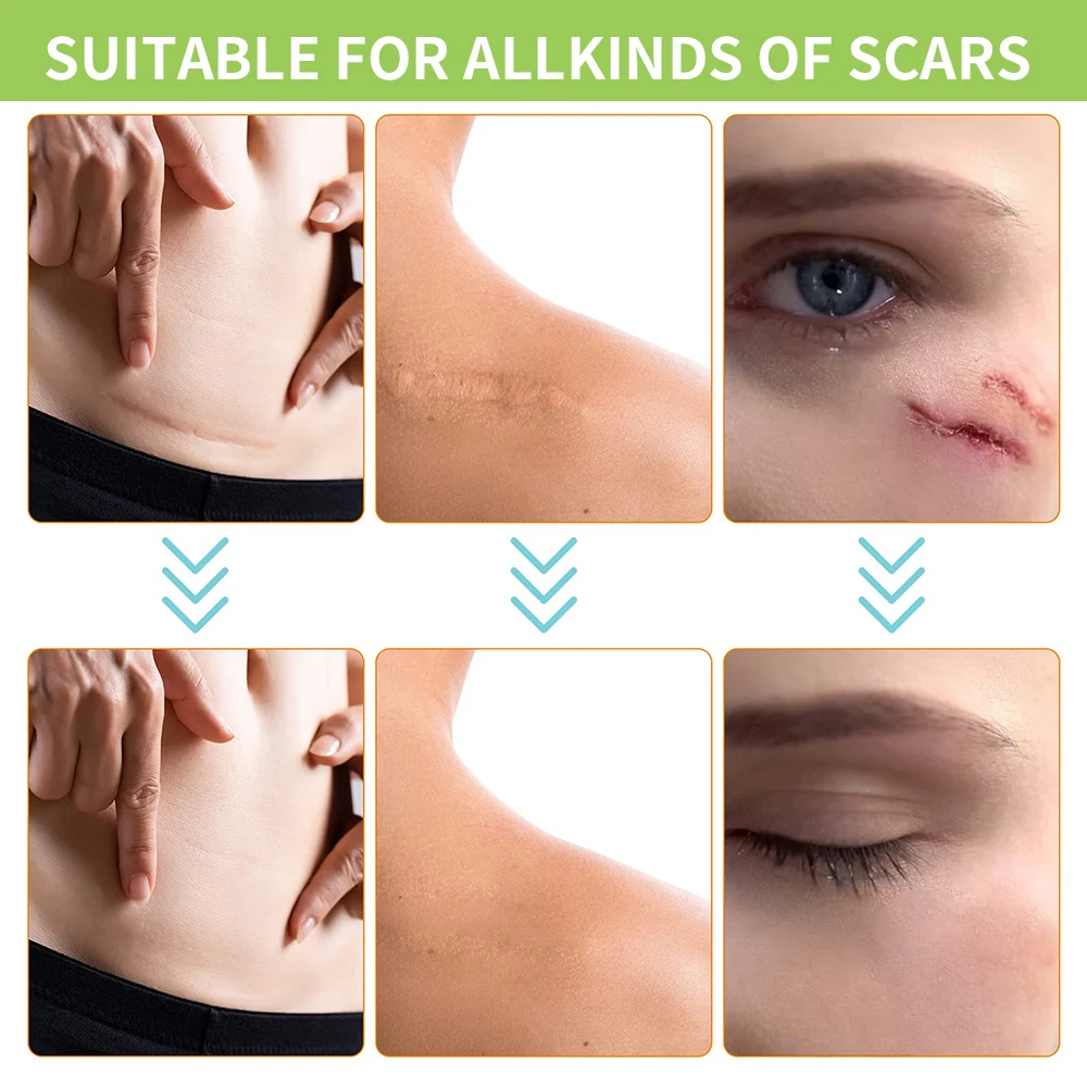1.5/3M silikonowe plastry na blizny usuwanie niewidoczna podkładka korektorowa żelowa wodoodporna taśma leczenie do operacji cesarskiego oparzenia keloidowe podnoszenie brzucha