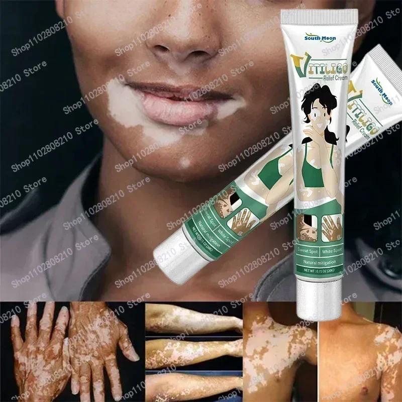 Organic Vitiligo Treatment With Herbal Extract for White Spot Ringworm Removal