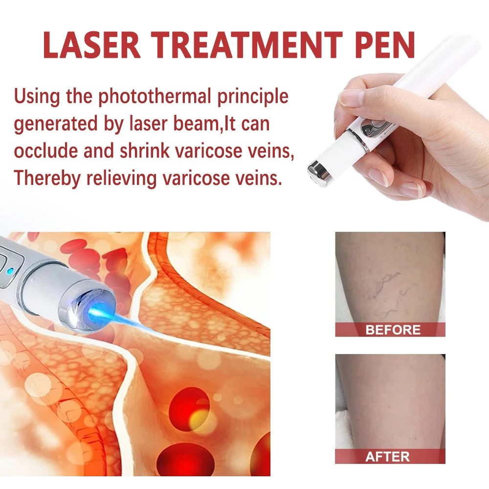 1-5pcs Varicose Veins Laser Pen Effective Eliminate Vasculitis Phlebitis Varicose Relieves Leg Bulge Pain Varicose Vein Cream