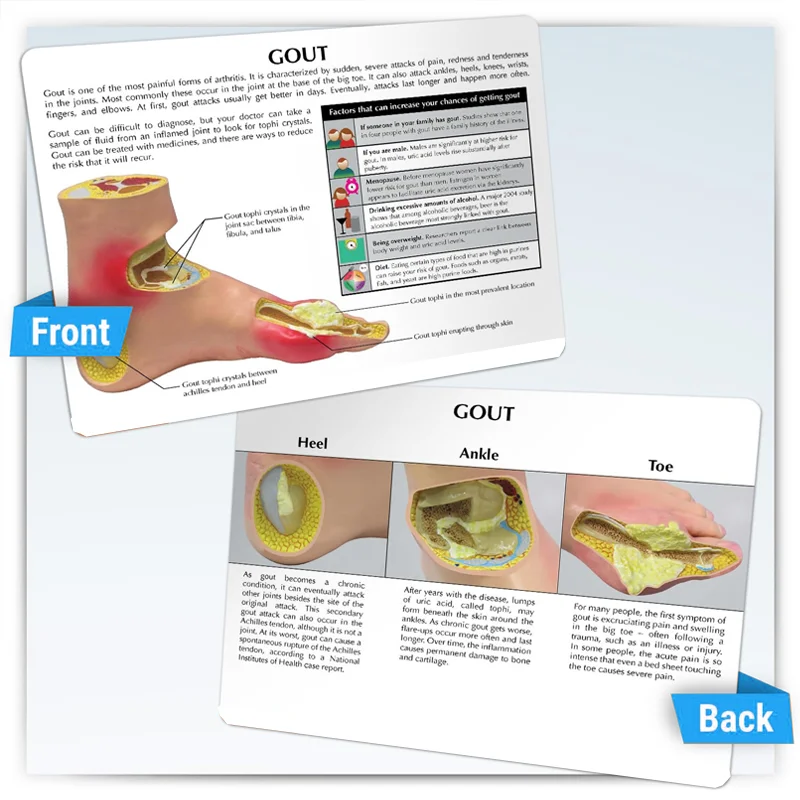 Pathological model of gout complications, medical model of foot and ankle joint