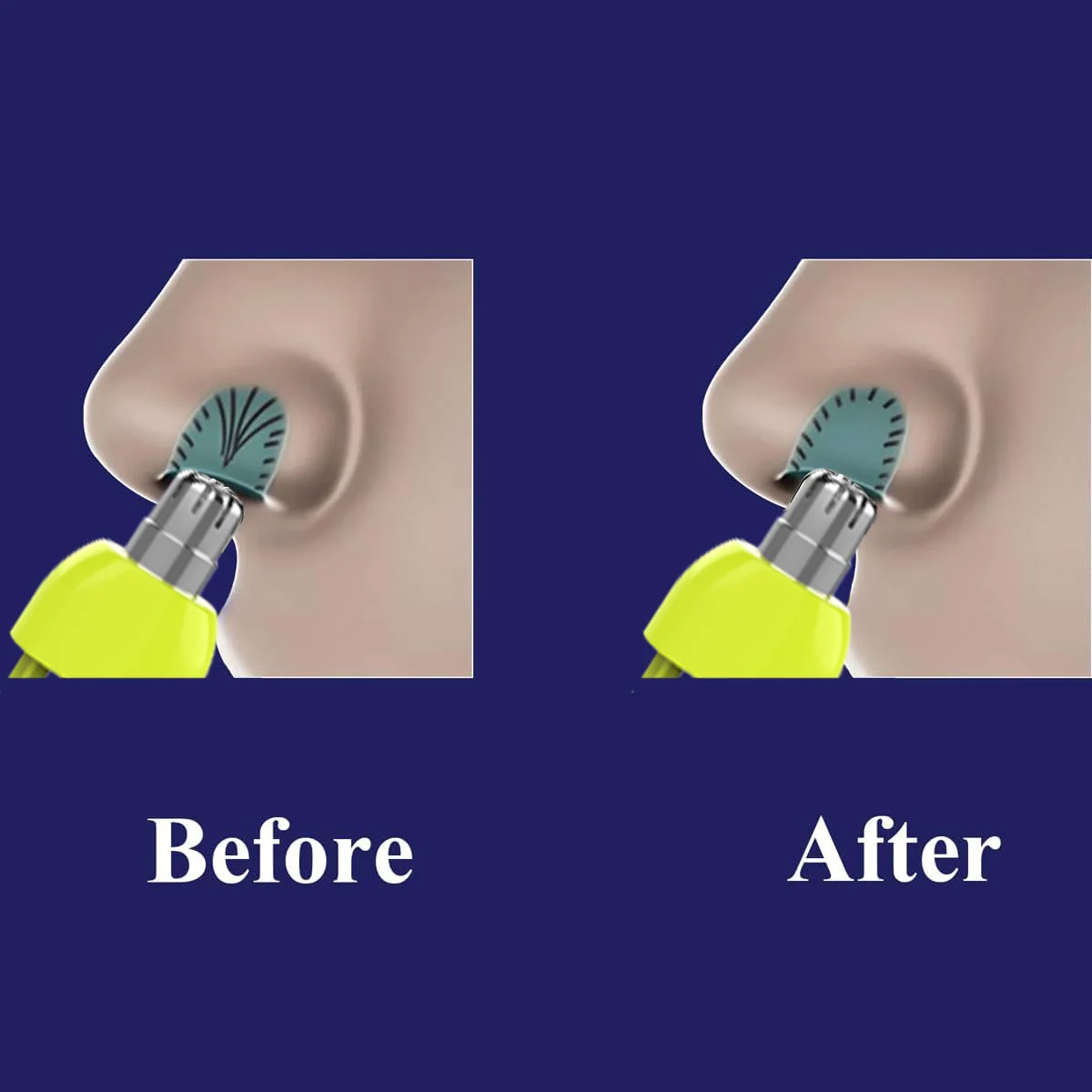 رؤوس بديلة لتشذيب شعر الأنف من Brangdy لفيليبس OneBlade QP2520 QP2630 QP6520 QP6530 ماكينة حلاقة قابلة للشطف بشفرة مزدوجة الحافة