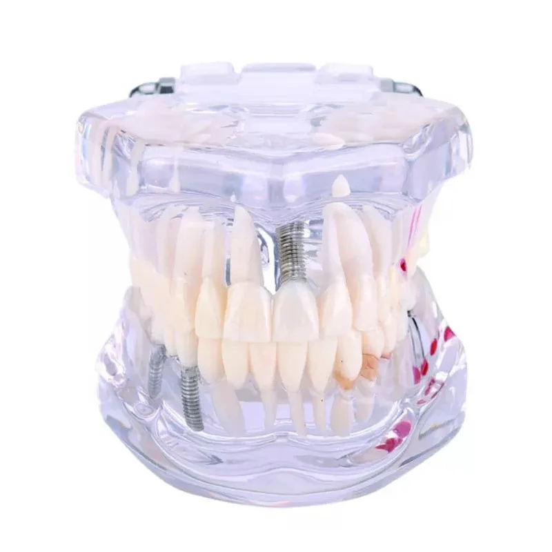 Restoration with Implant Education Dental Teeth Model for Hospital or School