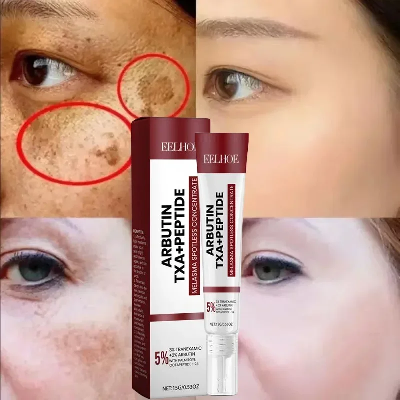 Powerful Spot-Removing Whiten Cream Brighten Skin Fast Eliminates Melanin Pigmentation Dark Spots Melasma Korean Skin Care