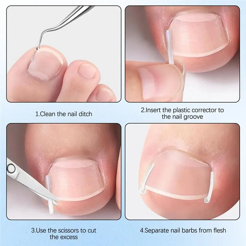 YCOC-Ingrown Toenail Corrector Set-Professional Tool Kit With Correction Strips, Removal Kit Included