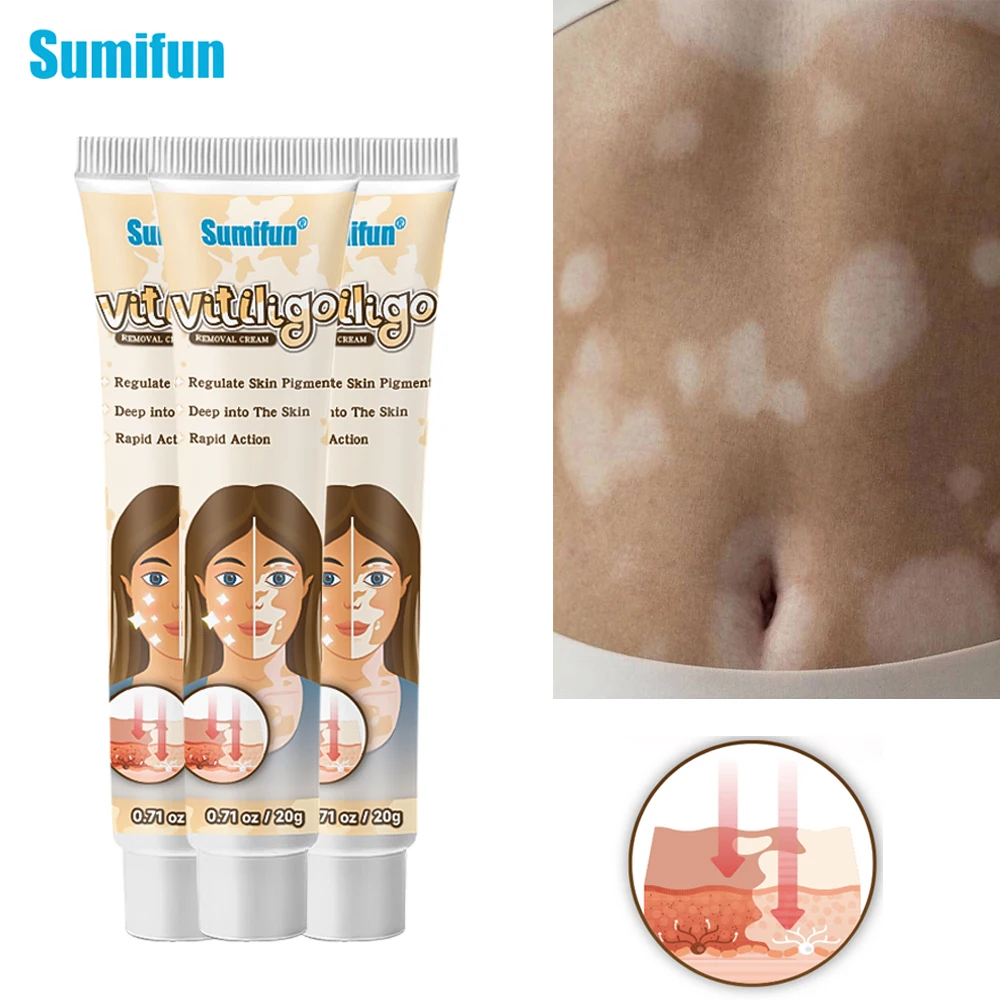 

1/3pcs Sumifun New Vitiligo Treatment Cream Remove White Spot Antibacterial Ointment Leukoplakia Melanin Skin Care Herbs Plaster