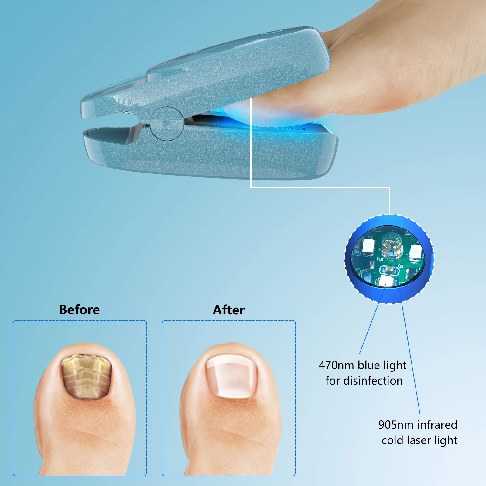 Blue Color Nail Fungus Laser Device 7 Minutes Painless Nail Treatments Device Toenails Onychomycosis Cure Machine 905nm LLLT