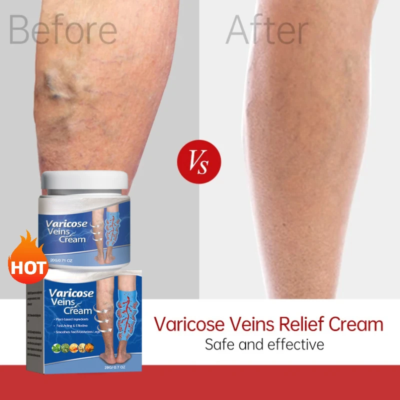

Varicose Vein Repair Cream Tongmai Effective Relieves Leg Bulge Pain Treatment Cream Vasculitis Phlebitis Remove Vein 20g
