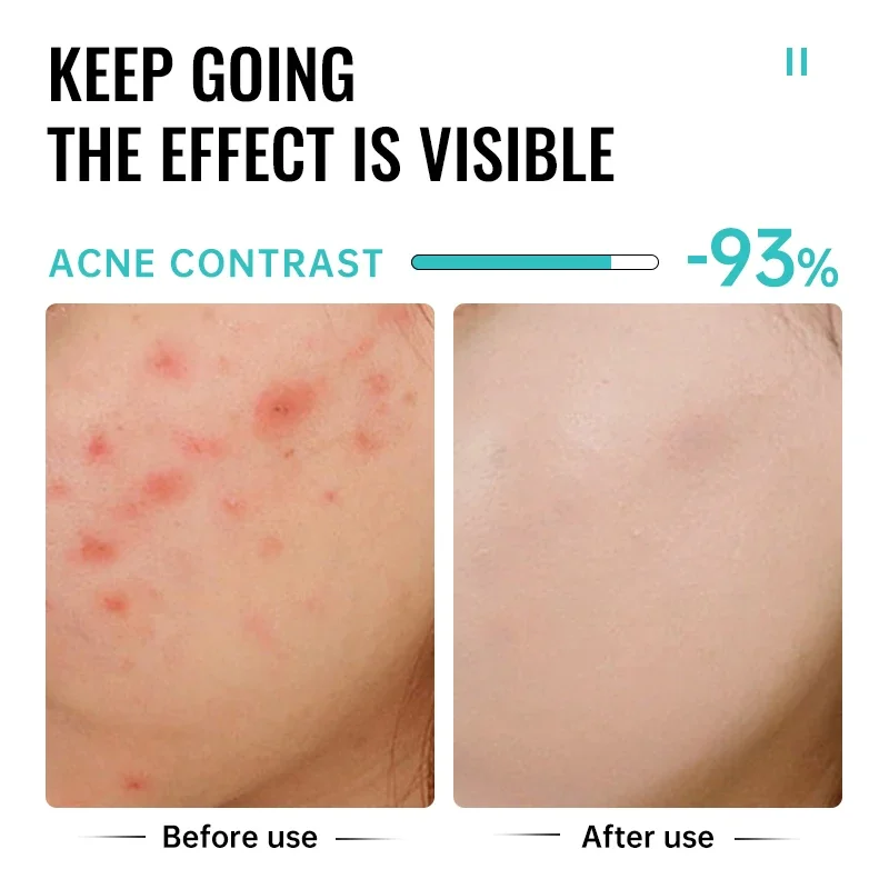 Salicylic Acid Acne Treatment Cream Repair Pimple Spots Serum Cleaning Pore Anti-acne Oil Control Moisturizer Smooth Skin Care