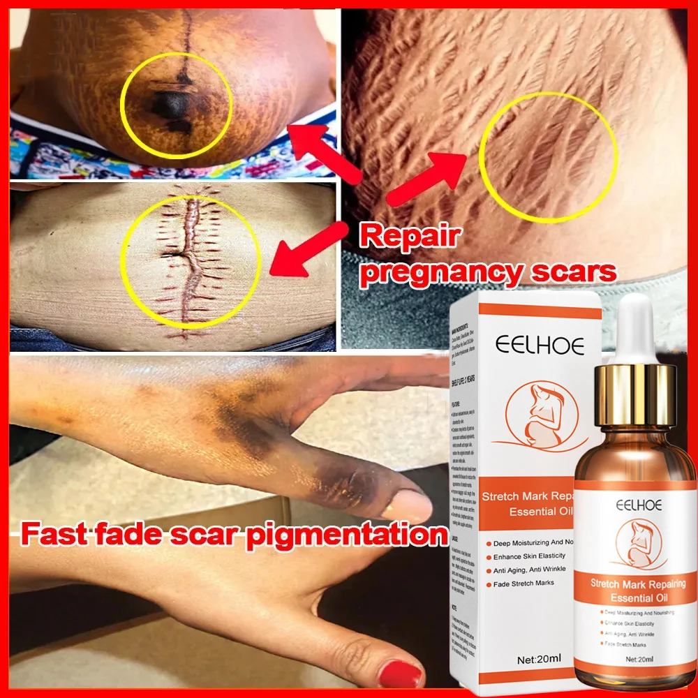 Stretch Marks Permanent Removal Serum Effective Treatment Stretch Marks Burn Surgical Scars Anti-Aging Firming Smooth Body Care