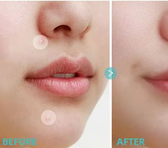 Gezichtsreparatie Acne Schone poriën Hydrateren en gladde huid Acne Patch Gezichtsstickers Huidverzorgingshulpmiddelen