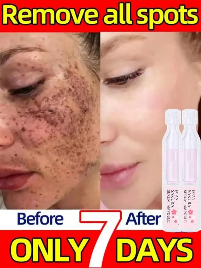 Clareador sardas rosto soro remover melasma mancha escura clareamento melanina iluminar melasma anti-envelhecimento essência produto de cuidados com a pele