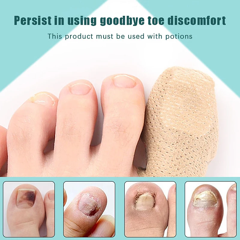 10 pezzi patch per funghi dell'unghia del piede patch per la riparazione delle unghie adesivi per la correzione delle unghie incarnite per la cura delle unghie scolorite o danneggiate