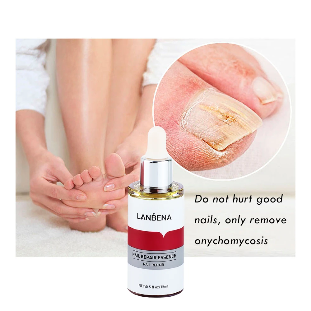 LANBENA 15ml Nail Repair Essence Serum Anti Infection Paronychia Onychomycosis Treatment Foot Care Nail Fungus Removal Gel