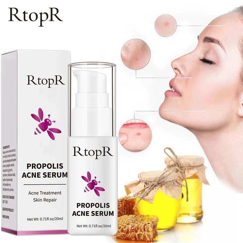 RtopR Propolis Acne Treatment Serum Repair Acne Brightening Shrink Pore Eliminates Acne Scar Spot Essence Oil control Serum 20ml
