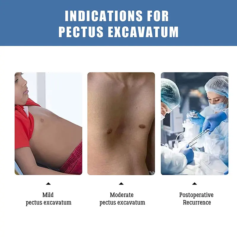 Excavatum Orthosis Brace  Sternal Depression Support  Sunken Sternum Deformity Braces for All Ages