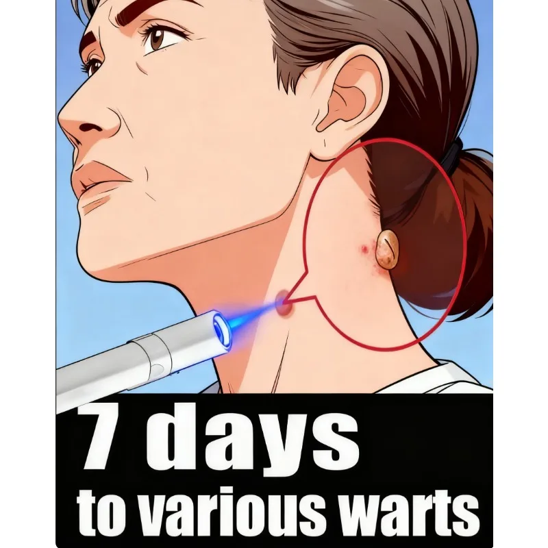 

Лазерная ручка синего цвета 2026, обновленная версия, для удаления бородавок, быстрое удаление шипованых бородавок, VC