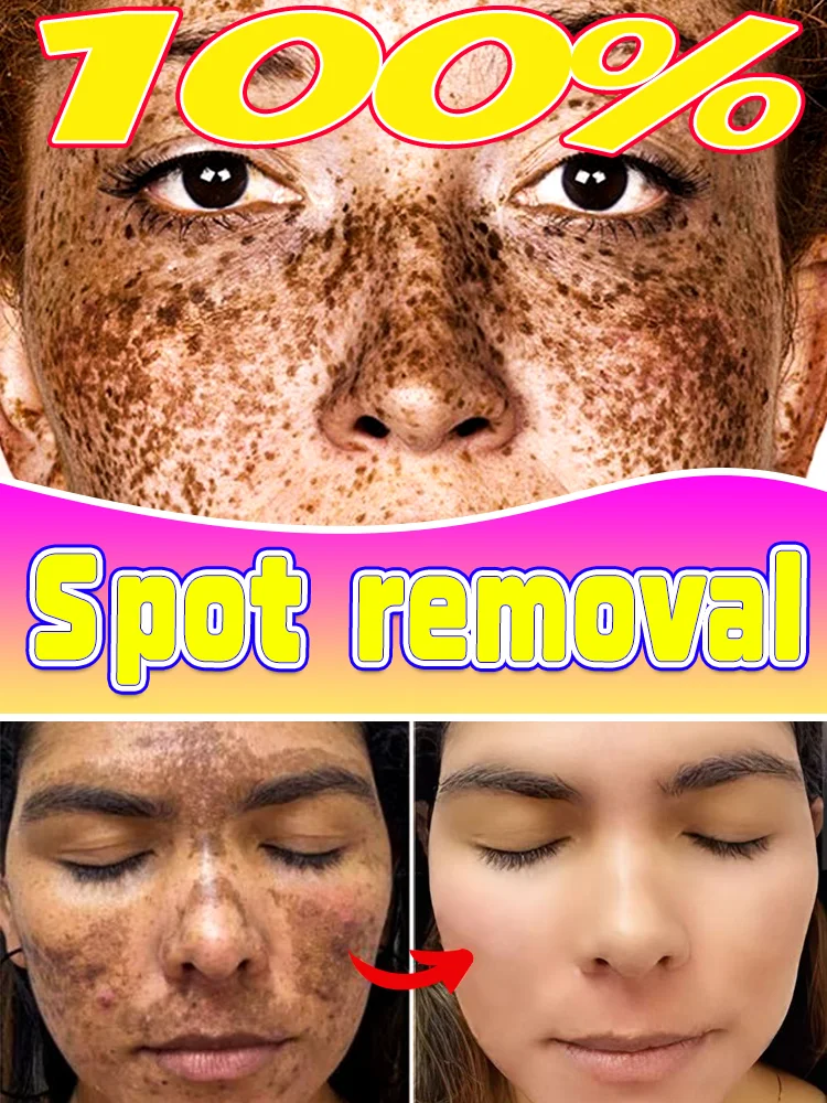 

100% effective and gentle, spot pigmentation disappears, Skin is 20 years younger! Say goodbye to the spots.