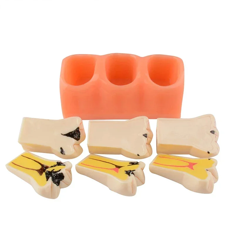 Dentist Teaching Tools Dental Decayed Teeth Model Denture Caries Disease Tooth Model Decomposition Decay Tooth Model