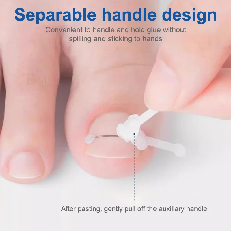 陥入爪矯正ツール 陥入爪治療用弾性パッチステッカー 矯正クリップブレース ペディキュアツール