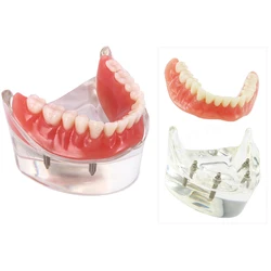 Implant dentystyczny Model zębów z Overdenture gorszy Demo 4 implanty Model nauczania dentystyczne do laboratoryjnych narzędzi demonstracyjnych M6003