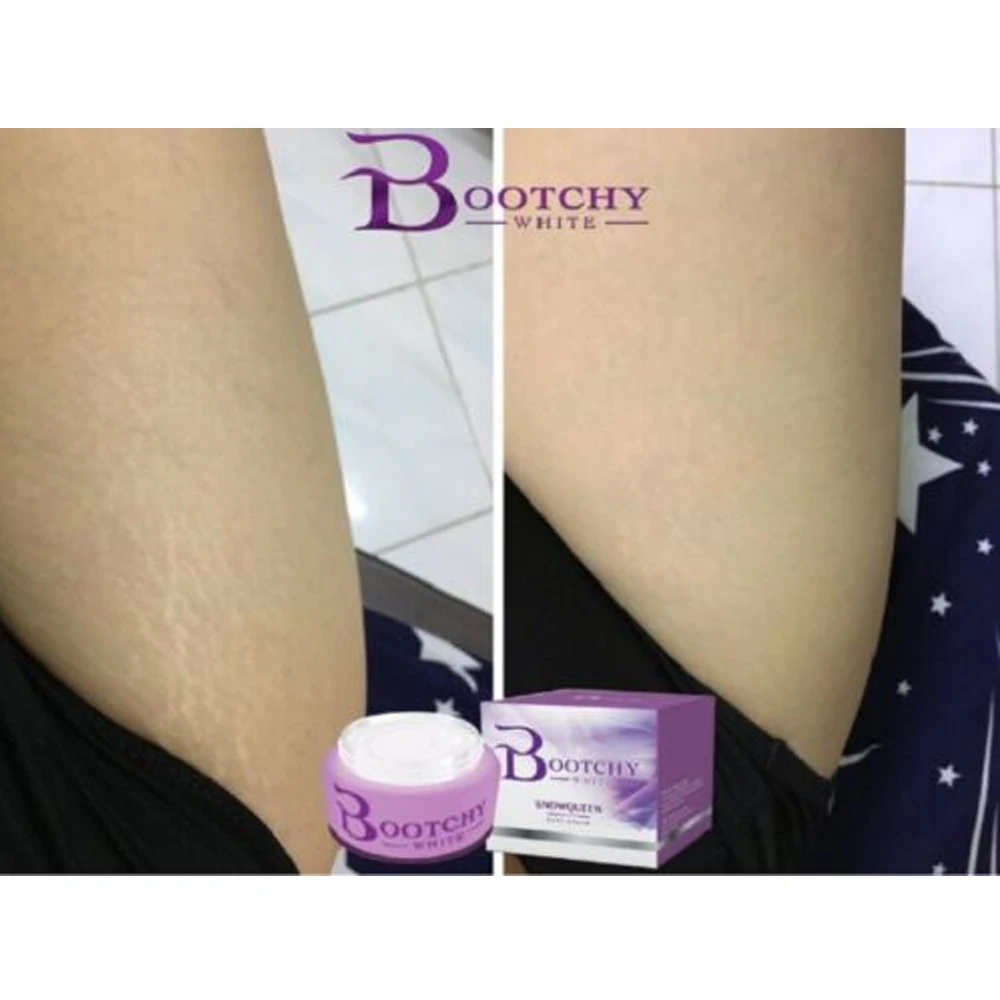 Bootchy White Body Reduce Dark Skin Stretch Marks Armpits Knees Elbows Buttocks Soften Brighten Skin 50g