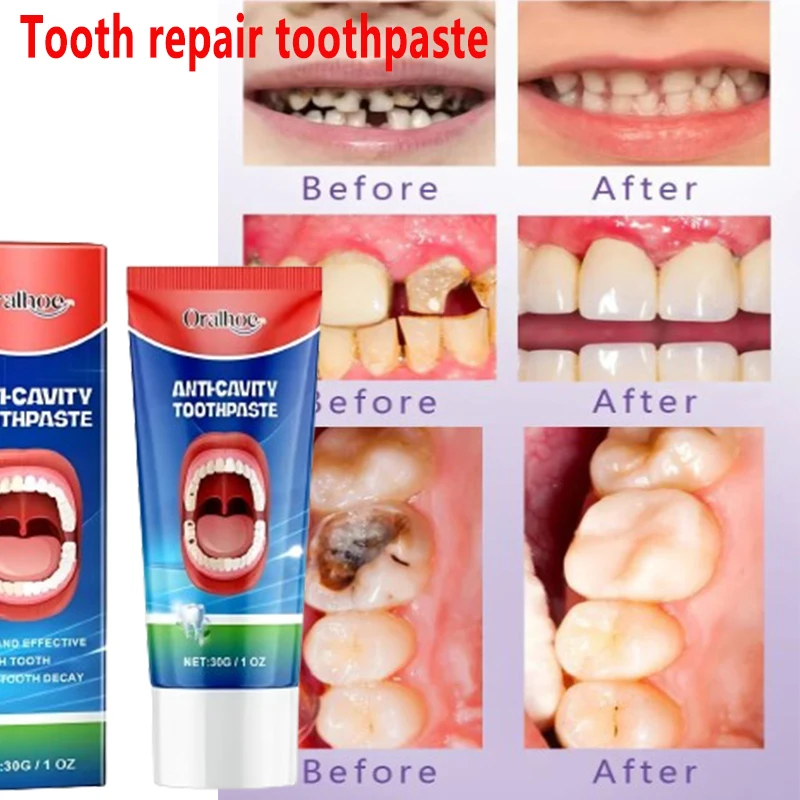 Anti Decay Toothpaste Dental Caries Repair Cream Prevent Tooth Decay Protect Teeth 30g