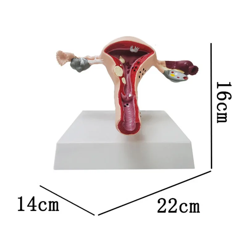 Medical Human Pathological Uterine And Ovarian Anatomical Model Gynecological Display Medical Teaching Supplies